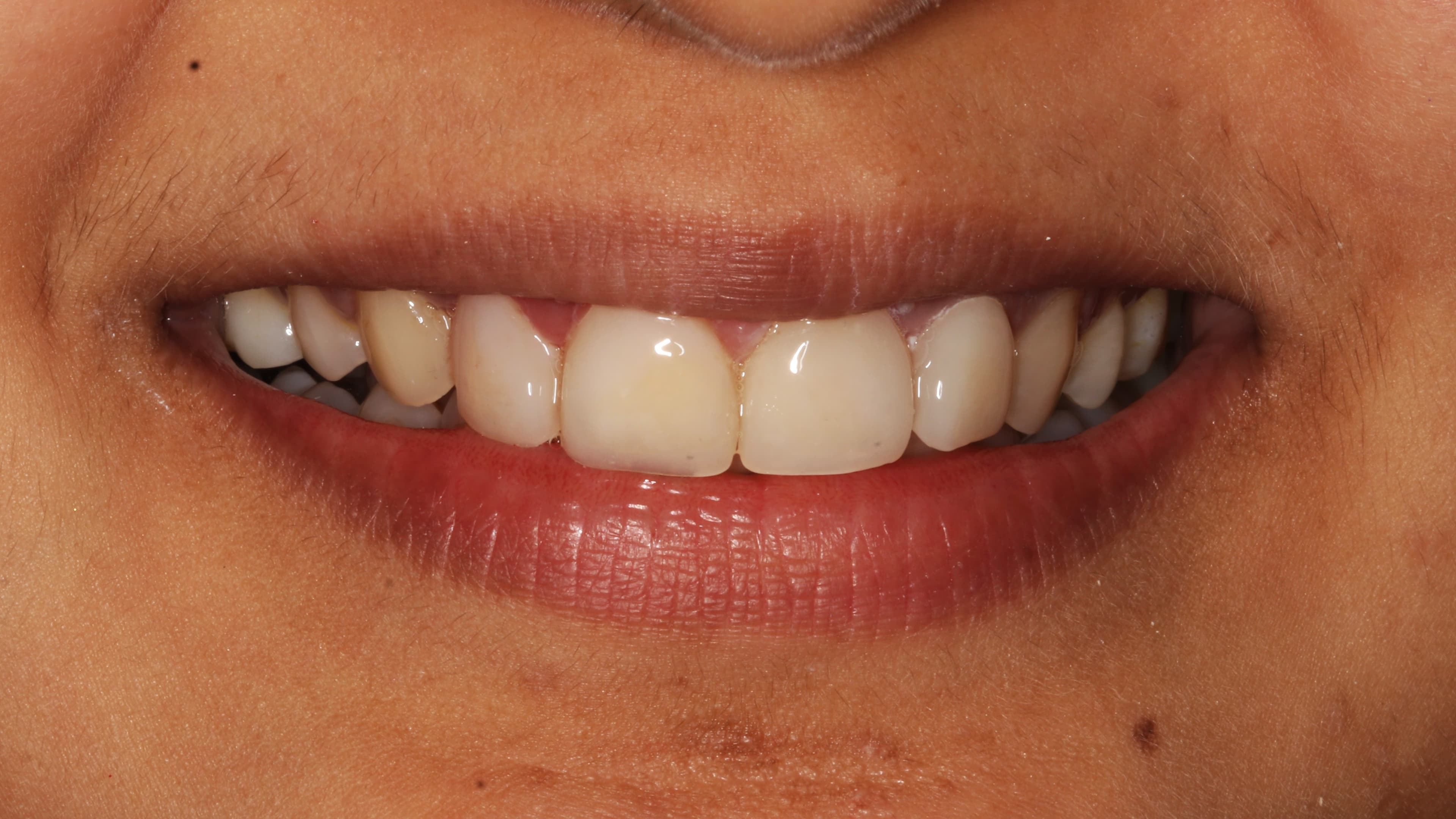 Po leczeniu ortodontycznym