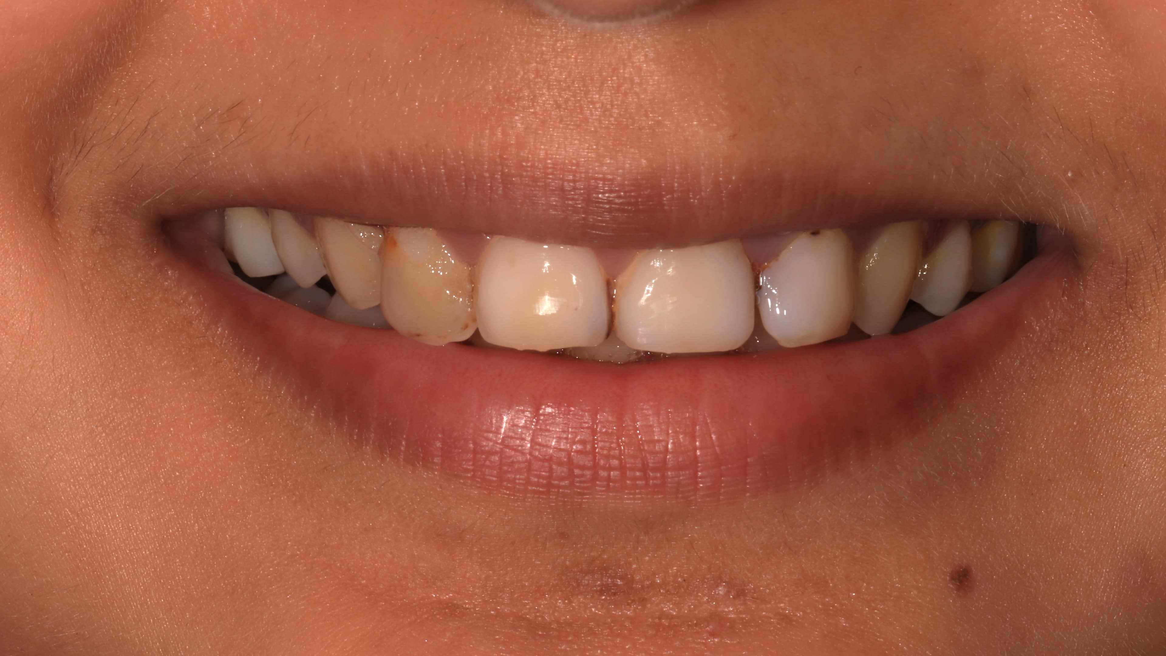 Przed leczeniem ortodontycznym